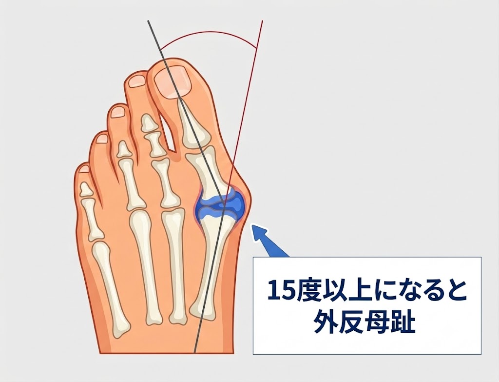 外反母趾角 15度以上の測り方