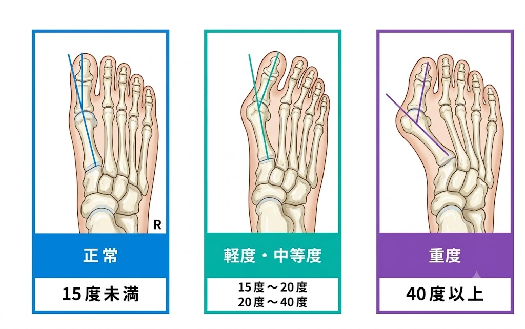 正常な足と外反母趾の足の比較