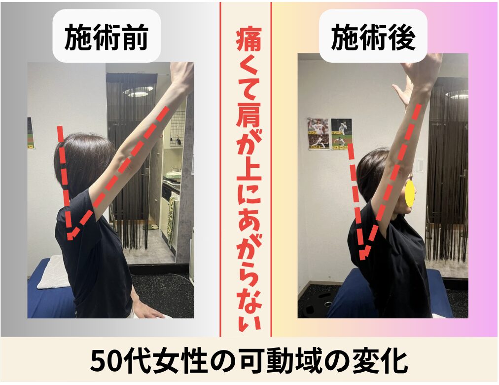 50代女性 肩が上がらない可動域の変化 ビフォーアフター｜大阪市旭区・関目高殿の整体院 友