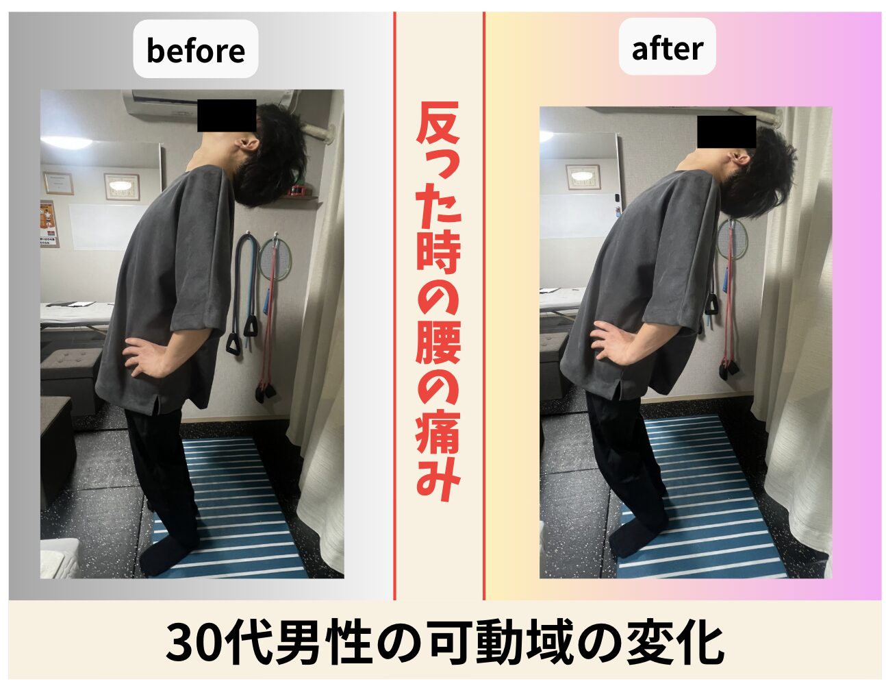 30代男性 反った時の腰の痛みの可動域の変化 ビフォーアフター｜大阪市旭区・関目高殿の整体院 友