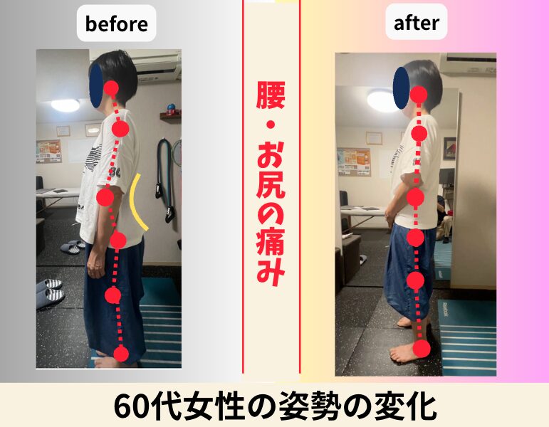60代女性 腰・お尻の痛みの姿勢の変化 ビフォーアフター｜大阪市旭区・関目高殿の整体院 友