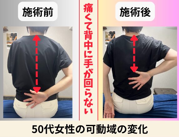 50代女性 背中に手が回らない可動域の変化 ビフォーアフター｜大阪市旭区・関目高殿の整体院 友