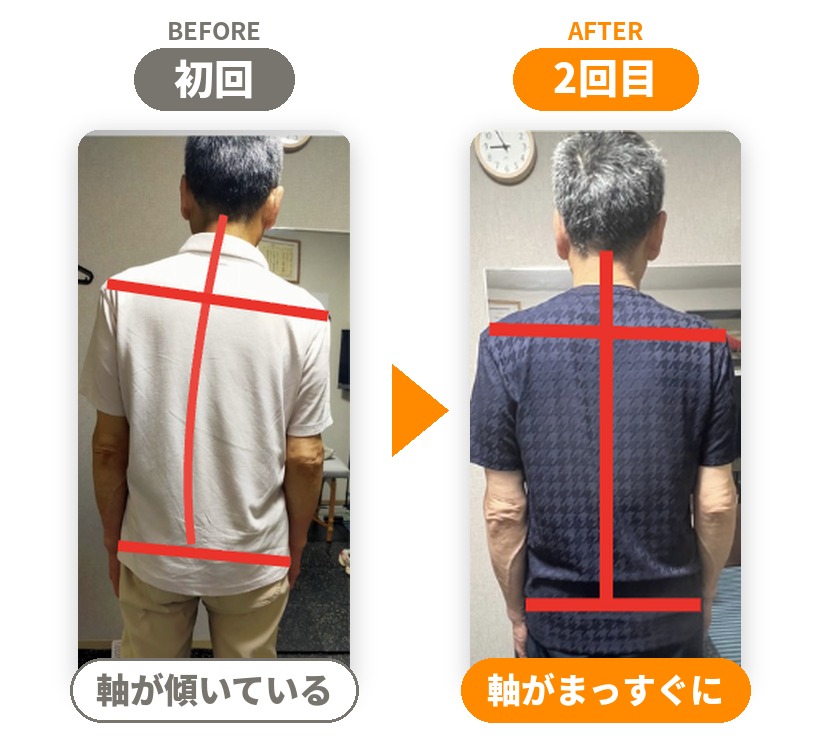 脊柱管狭窄症と診断された60代男性の初回と2回目の姿勢比較。傾いていた背骨の軸がまっすぐに｜大阪市旭区・関目高殿の整体院 友